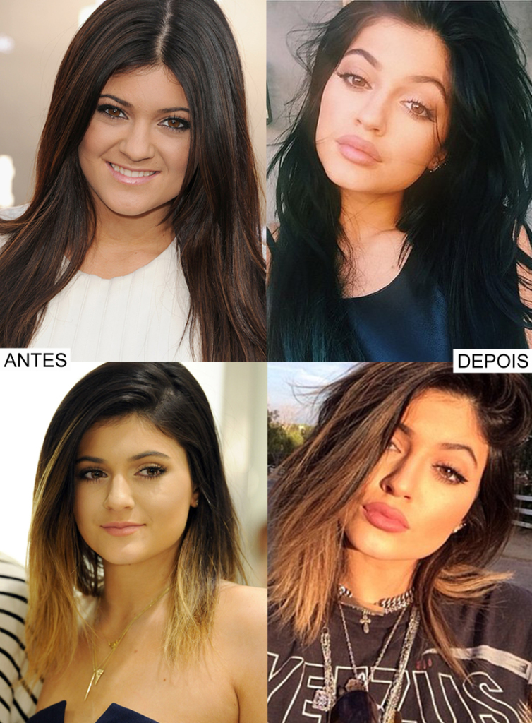 Kylie_Jenne_lips_secret_segredo_boca_before_after